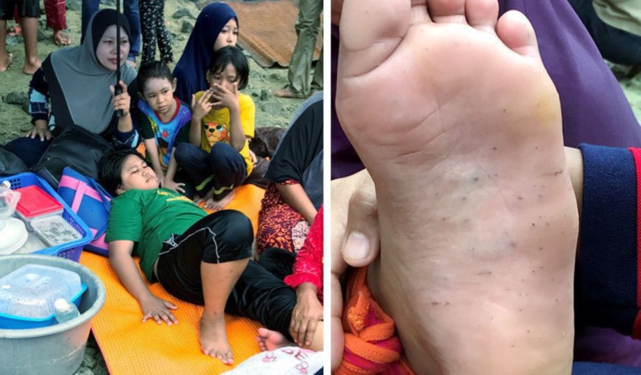 WAHYUNI ditenangkan ahli keluarganya selepas kaki kirinya terkena duri landak laut ketika mandi di pantai Payang, Lahad Datu. Gambar kanan, kesan tusukan duri landak laut.