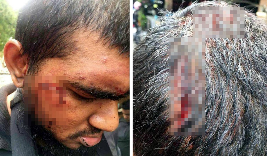SEORANG lelaki cedera di muka dan kepala selepas dipukul  dalam pergaduhan di pusat hiburan di Jalan Penang.