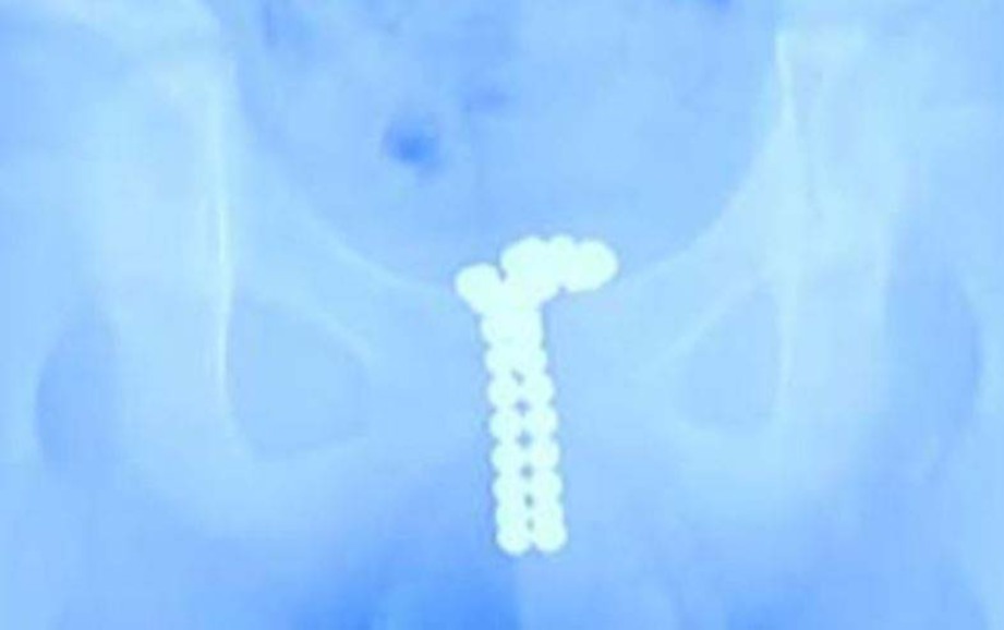 GAMBAR X-ray yang menunjukkan kedudukan bebola magnet di dalam saluran kencing kanak-kanak itu. FOTO Daily Mirror