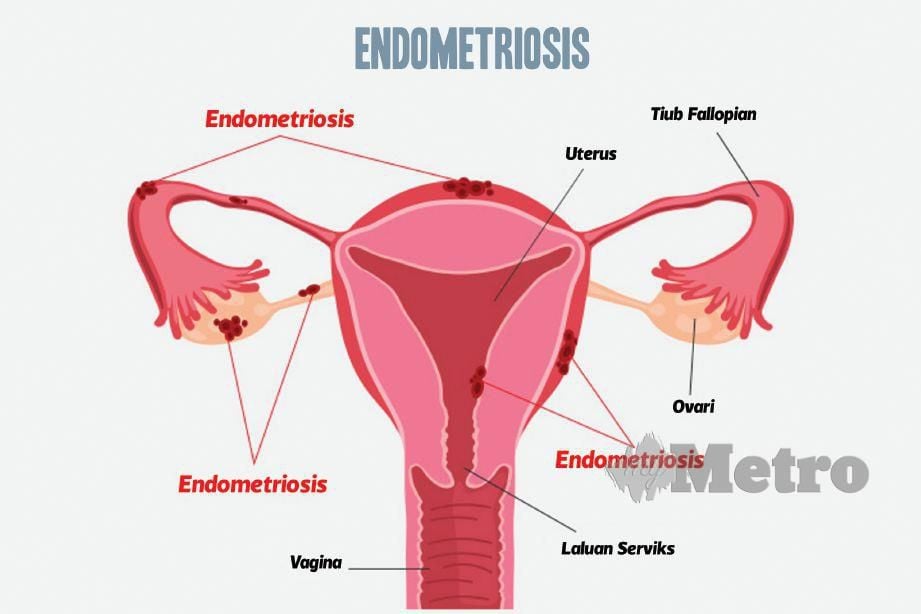Endometriosis maksud