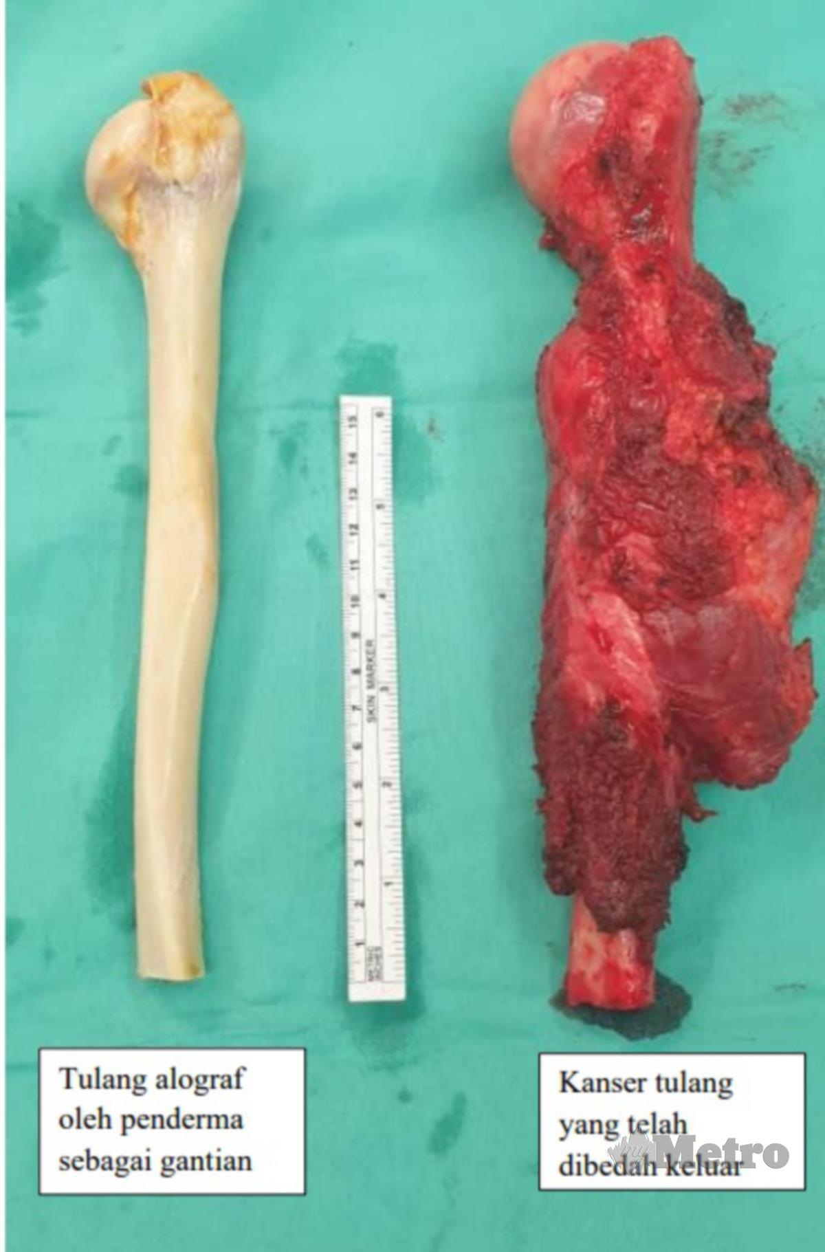 TULANG alograf oleh penderma sebagai gentian (kiri), barah tulang yang dikeluarkan daripada pembedahan (kanan).