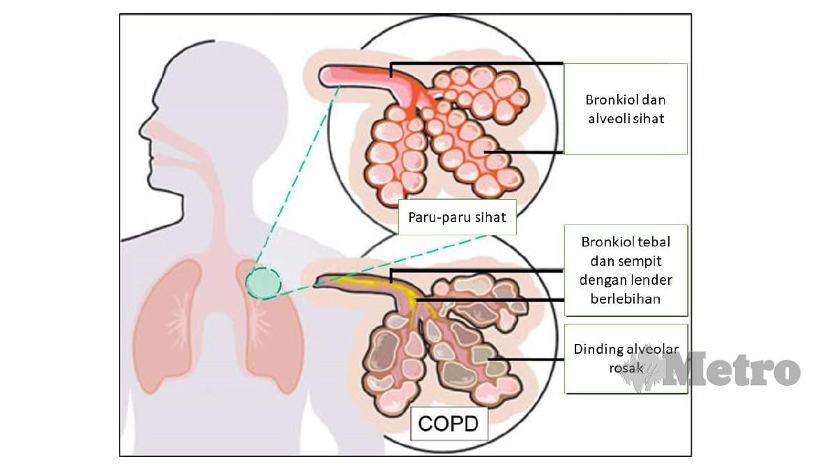 PERBANDINGAN paru-paru sihat dengan COPD. 