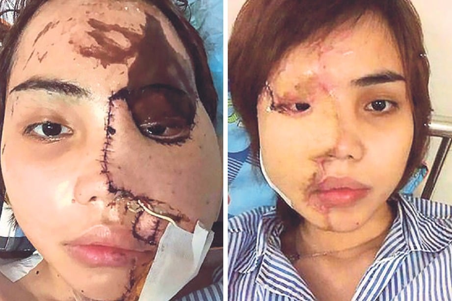WAJAH Vy selepas disimbah asid. Gambar kanan: Doktor membetulkan wajah Vy melalui 10 pembedahan.