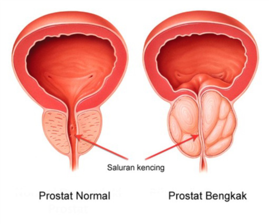 PERBEZAAN prostat normal dan bengkak. 