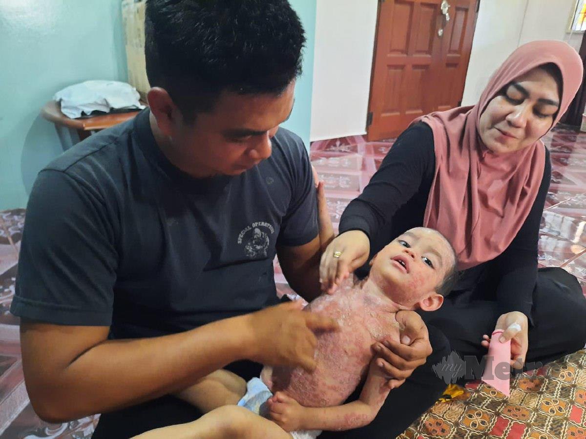 FATIN Suhana menyapu krim pelembab pada kulit anaknya Muhammad Izzat Rafael yang mengidap penyakit Pustular psoriasis. FOTO Noorazura Abdul Rahman