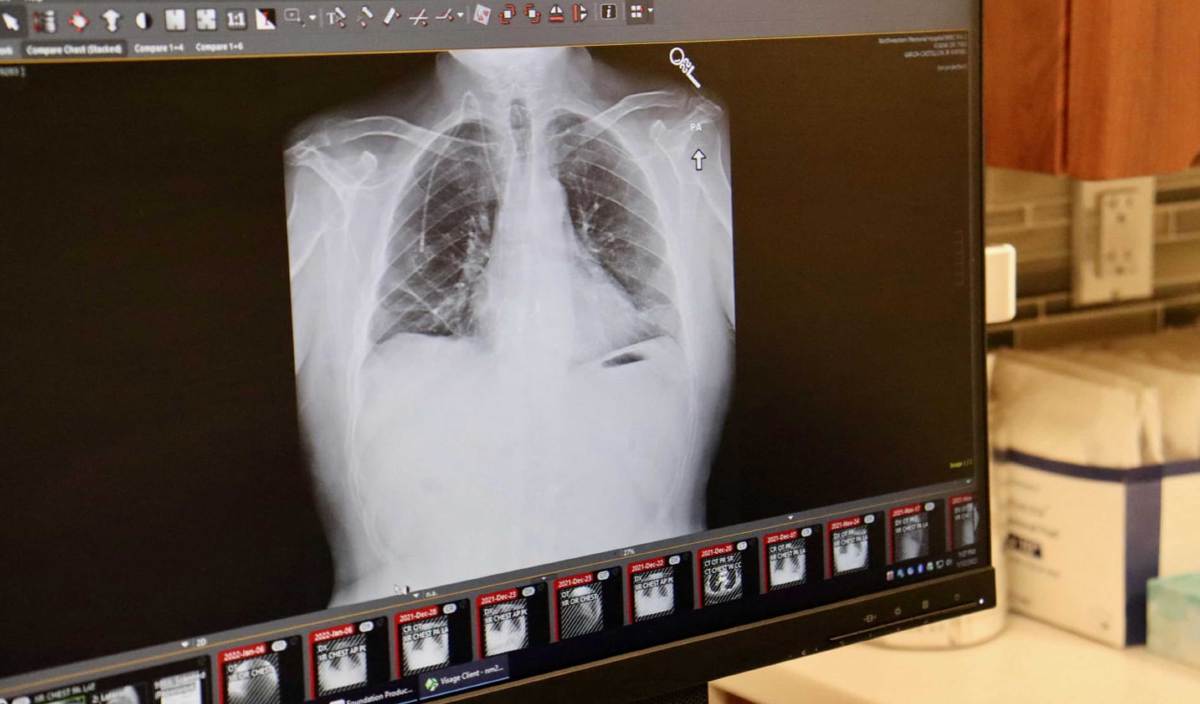 PAPARAN x-ray paru-paru baharu Albert Khoury. FOTO AFP/ Northwestern Medicine