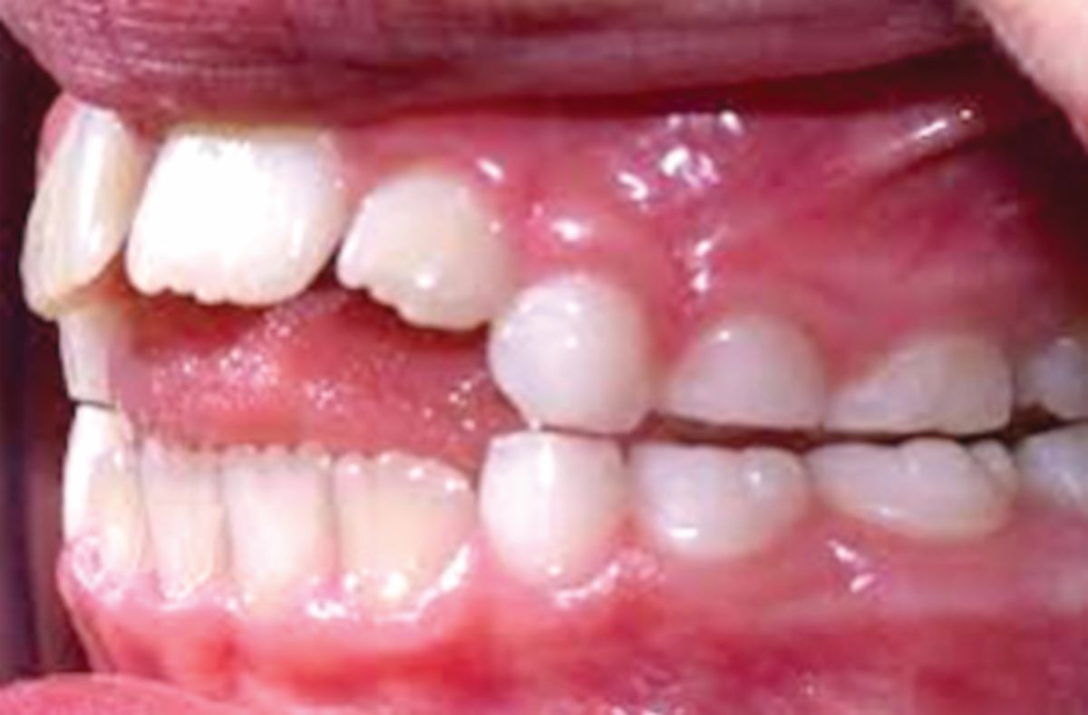 ‘OPEN bite’ gigitan gigi atas dan bawah tidak rapat disebabkan tabiat kronik menghisap jari.