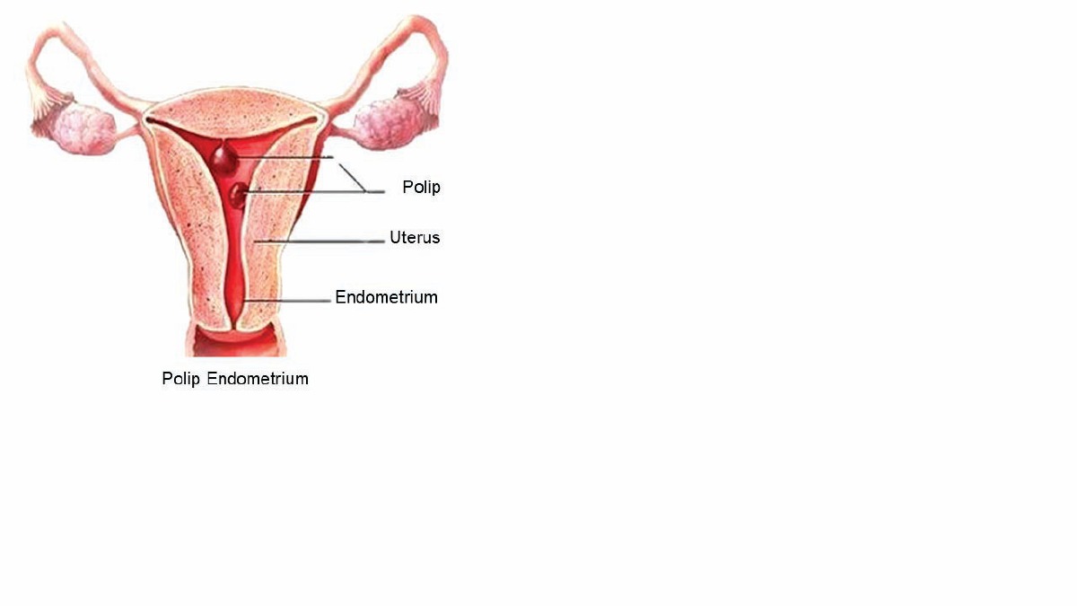 GAMBARAN polip yang menjadi penyebab pendarahan rahim tidak normal.