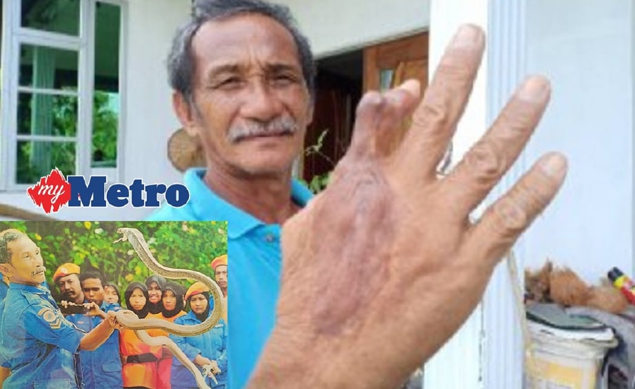 SHAMSU menunjukkan tangan dan jarinya yang bengkok akibat dipatuk ular tedung selar pada Jun tahun 2000 di rumahnya di Kampung Hujung Ambar. FOTO/NOORAZURA ABDUL RAHMAN