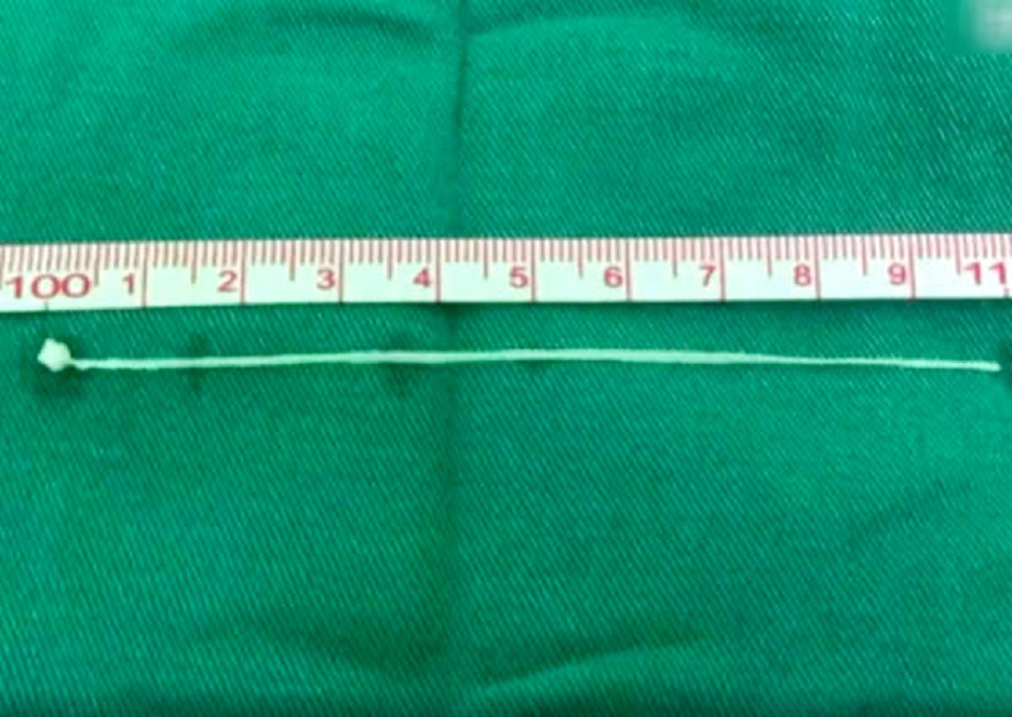SEEKOR cacing sepanjang 10 sentimeter yang dikeluarkan. FOTO youtube