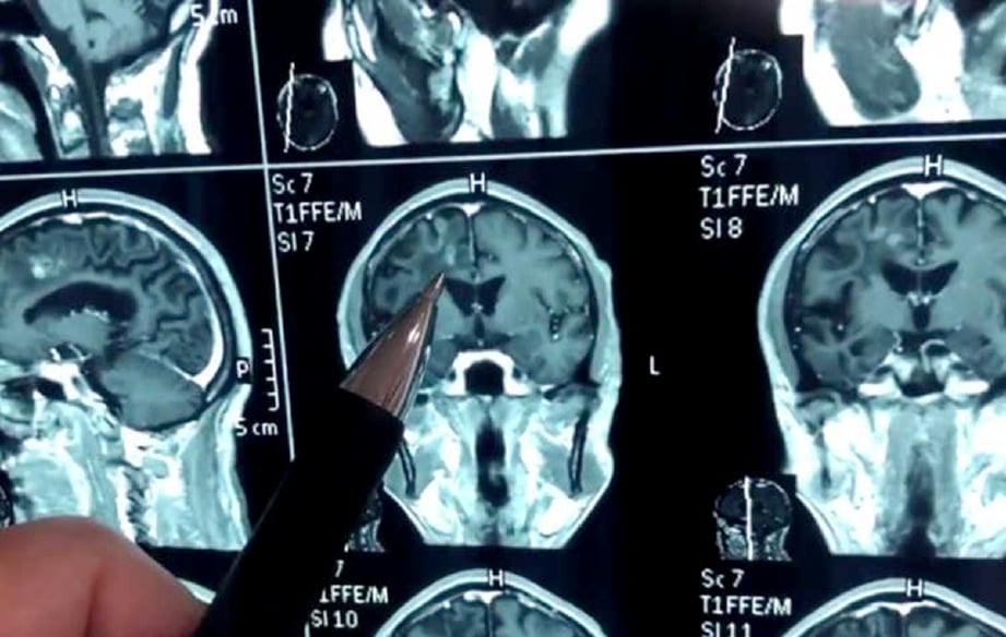 X-RAY menunjukkan cacing yang berada di dalam otak Zhang. FOTO youtube