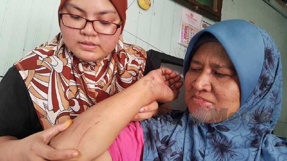 RAHIMAH menunjukkan luka yang dijahit kepada anak bongsunya, Nur Syazwani Alias, 21 ketika ditemui di rumahnya di Kampung Pauh Lima, Kota Bharu. FOTO Nor Amalina Alias