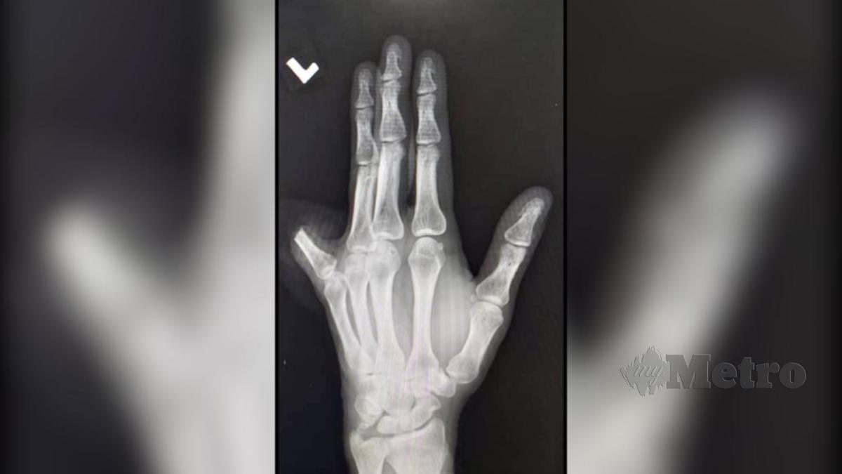 DOKTOR pakar mengesahkan jari kelingking Shahronizam tidak dapat diselamatkan kerana urat arteri sudah putus.