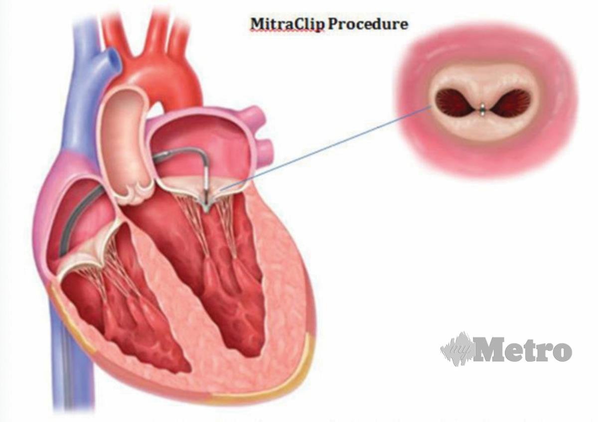KLIP Mitra teknologi terkini dalam merawat jantung.