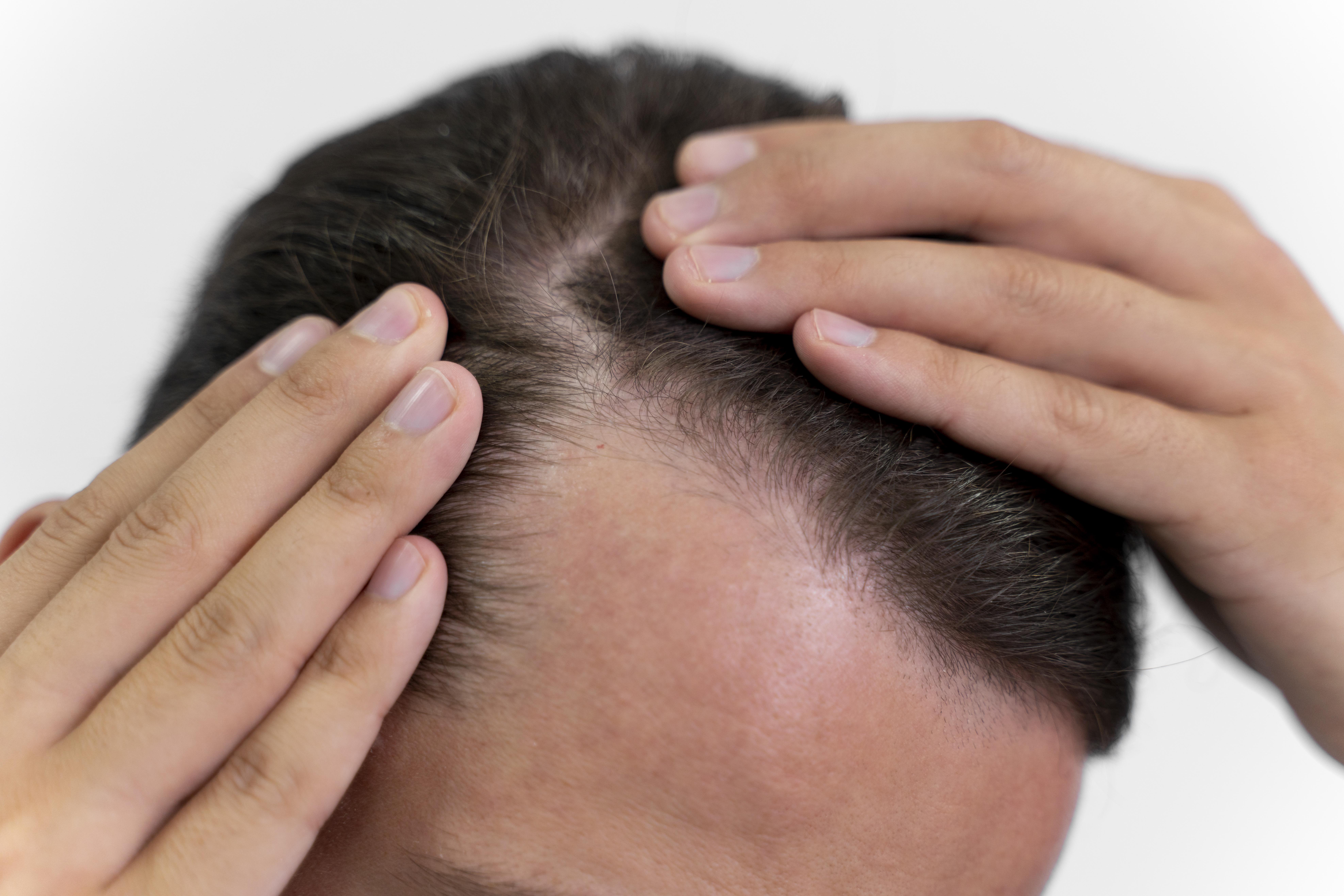 Keguguran rambut atau kebotakan mengikut corak lelaki juga dipengaruhi pelbagai faktor antaranya keturunan - FOTO Hiasan
