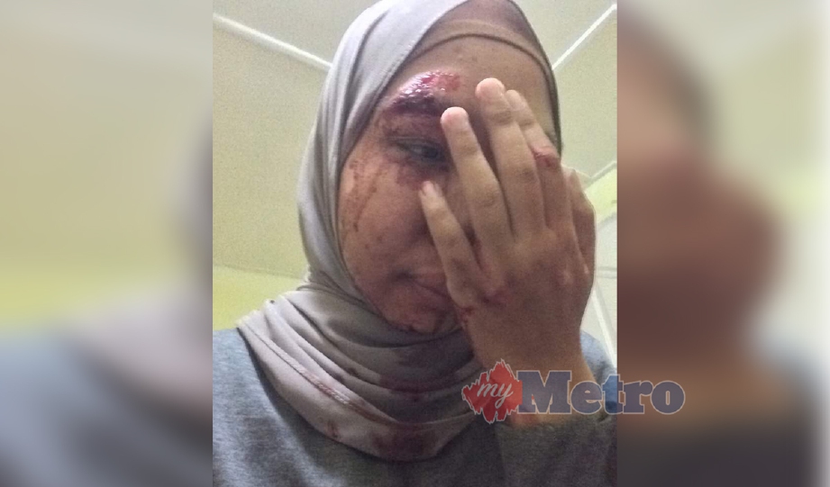 Aishah yang berlumuran darah akibat terjatuh dari motosikalnya selepas cubaan ragut di Kota Samarahan, Sarawak, malam tadi.  - Foto Ihsan Aishah