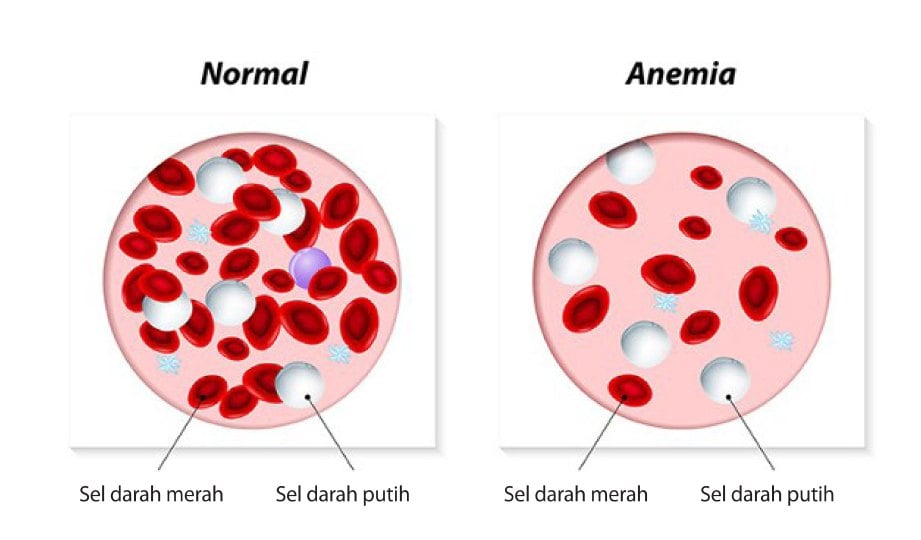 PERBANDINGAN sel darah merah dalam darah normal dan anemia.