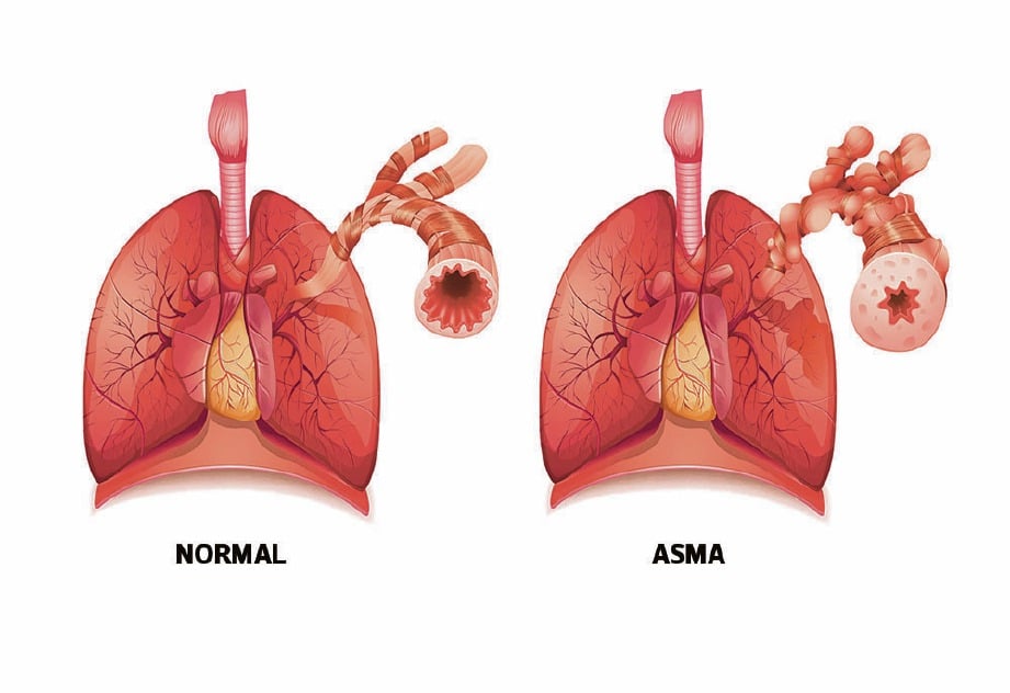 PERBEZAAN saluran udara paru-paru individu normal dan pesakit.