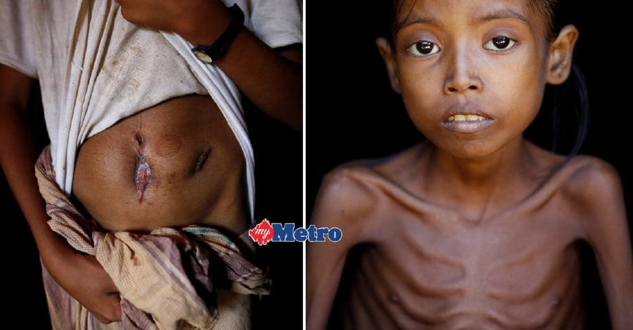 Gambar kanan menunjukkan keadaan kanak-kanak perempuan Rohingya, Ismot Ara, 7, yang sakit di kem pelarian Cox's Bazar, Bangladesh. Gambar kiri, Mohammad Shobaik, 12, menunjukkan kesan tembakan di perutnya. - Foto REUTERS