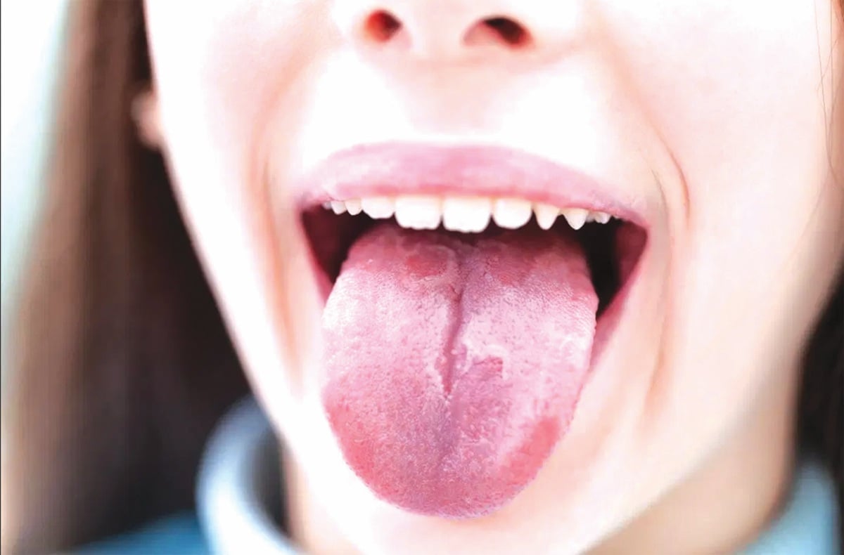 RADANG lidah mengakibatkan individu mengalami perubahan cara makan, bercakap. - FOTO Google