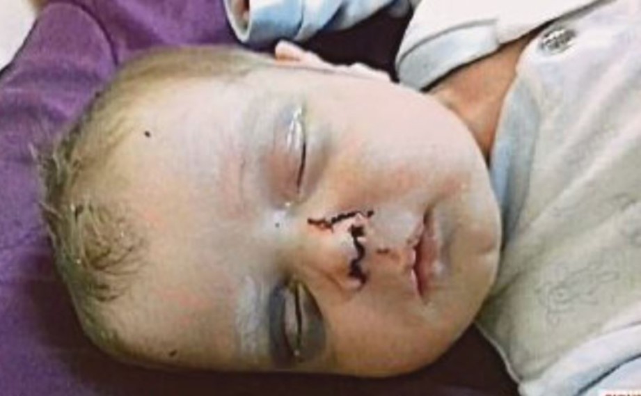 DOKTOR mengesyaki tengkorak bayi ini retak.