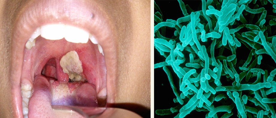 Jangkitan difteria pada tekak dan gambar kanan, bakteria Corynebacterium Diphteriae punya penyakit itu. - Foto healthline.com/Alain Grillet 