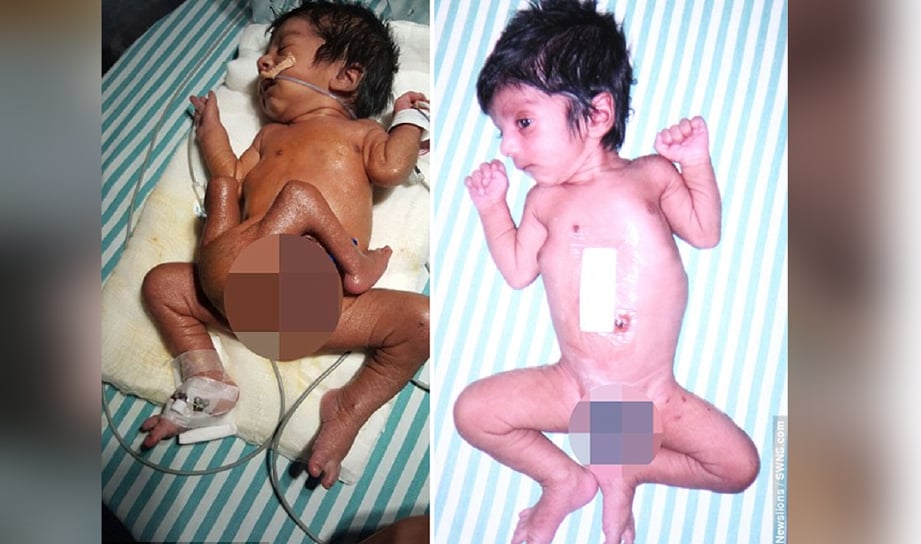 Keadaan bayi lelaki yang dilahirkan dengan empat kaki sebelum dan selepas pembedahan.