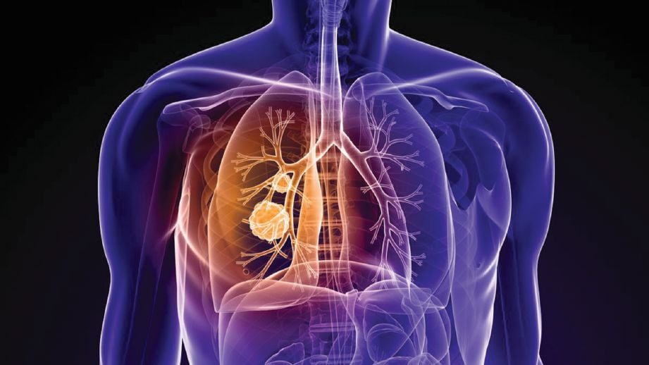 RAWATAN imunoterapi membantu memanjangkan jangka hayat pesakit barah paru-paru peringkat akhir.