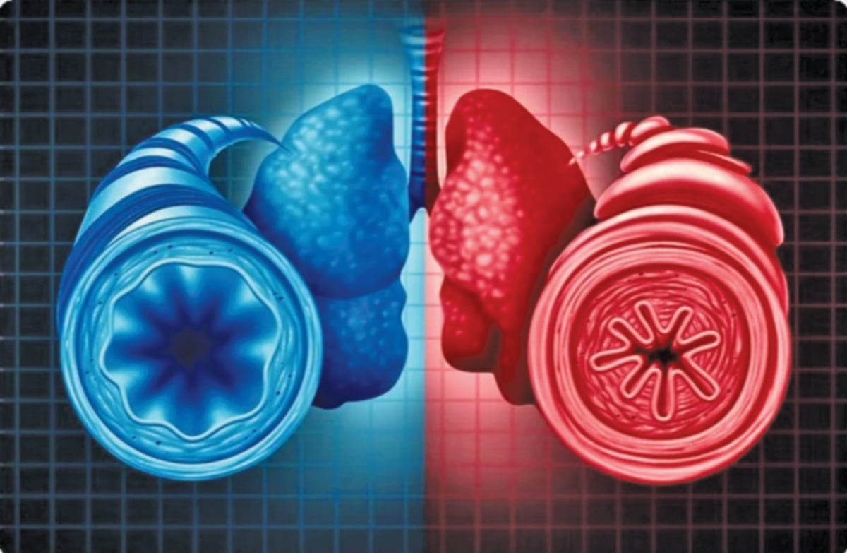 SALURAN pernafasan normal (kiri) manakala saluran pernafasan dengan asma (kanan).