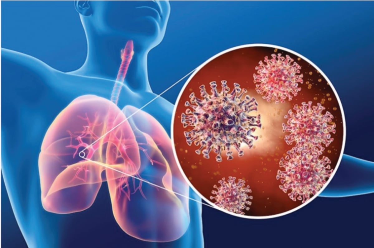 SERANGAN virus SARS-CoV-2 merosakkan tisu paru-paru menyebabkan batuk berpanjangan. 