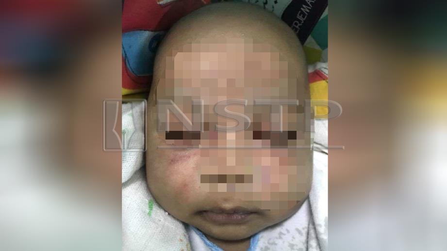KESAN lebam pada muka serta luka di tepi mulut bayi lelaki berusia dua bulan yang dipercayai dicubit dan dipukul pengasuhnya di Taman Equine, Serdang, 23 Oktober lalu. FOTO ihsan ahli keluarga mangsa.