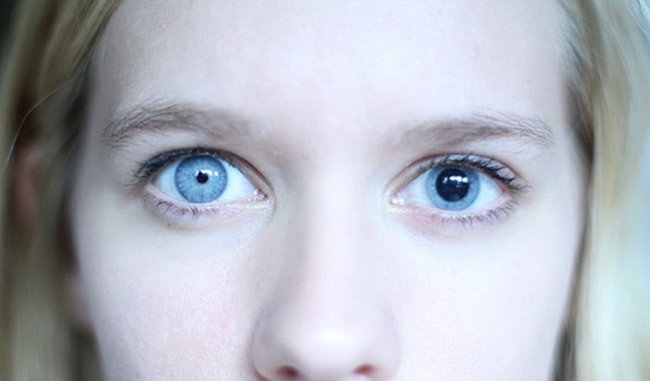 PERBEZAAN saiz anak mata perlu diberi perhatian serius.