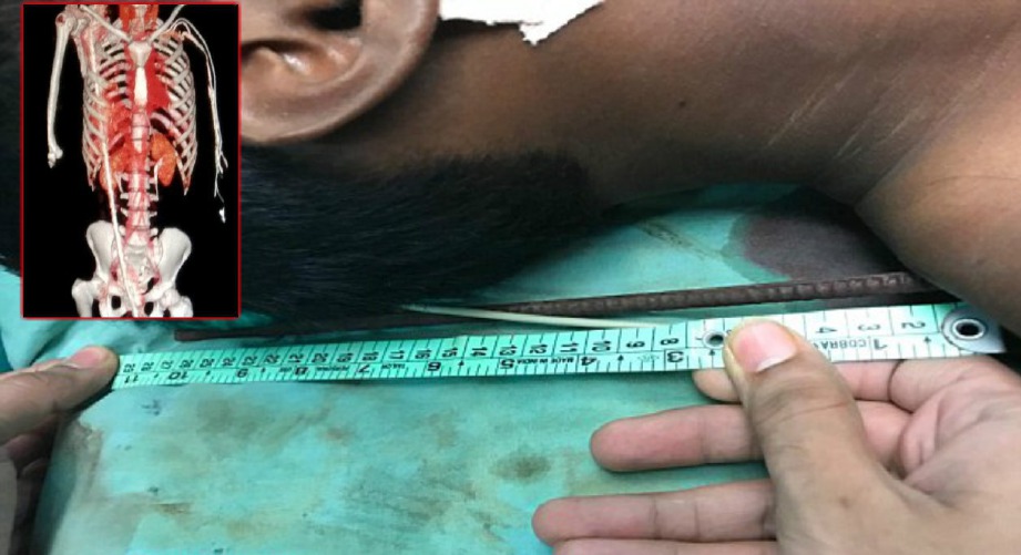 BESI yang tertusuk pada badan seorang lelaki sehingga menembusi lehernya dalam kejadian di New Delhi, India. FOTO Ihsan Daily Mail
