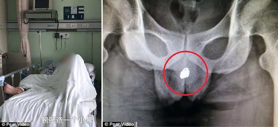 Imbasan X-ray menunjukkan mangga yang tersangkut dalam pundi kencing seorang lelaki di Fuzhou, China. 