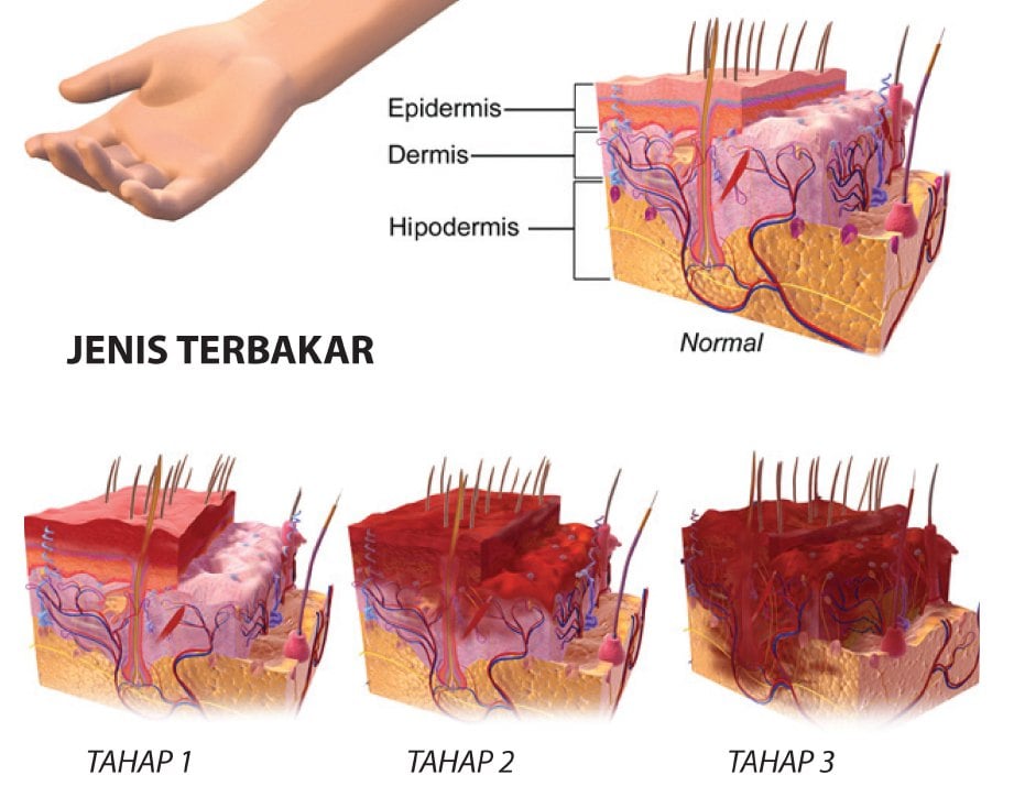 Disebabkan Tragedi Mi Segera Gadis Ini Fobia Cerek Idea Rendam Kaki Dalam Air Sejuk Sia Sia Tak Sakit Sampai Hospital Melecur Tahap 4 Viral Mstar