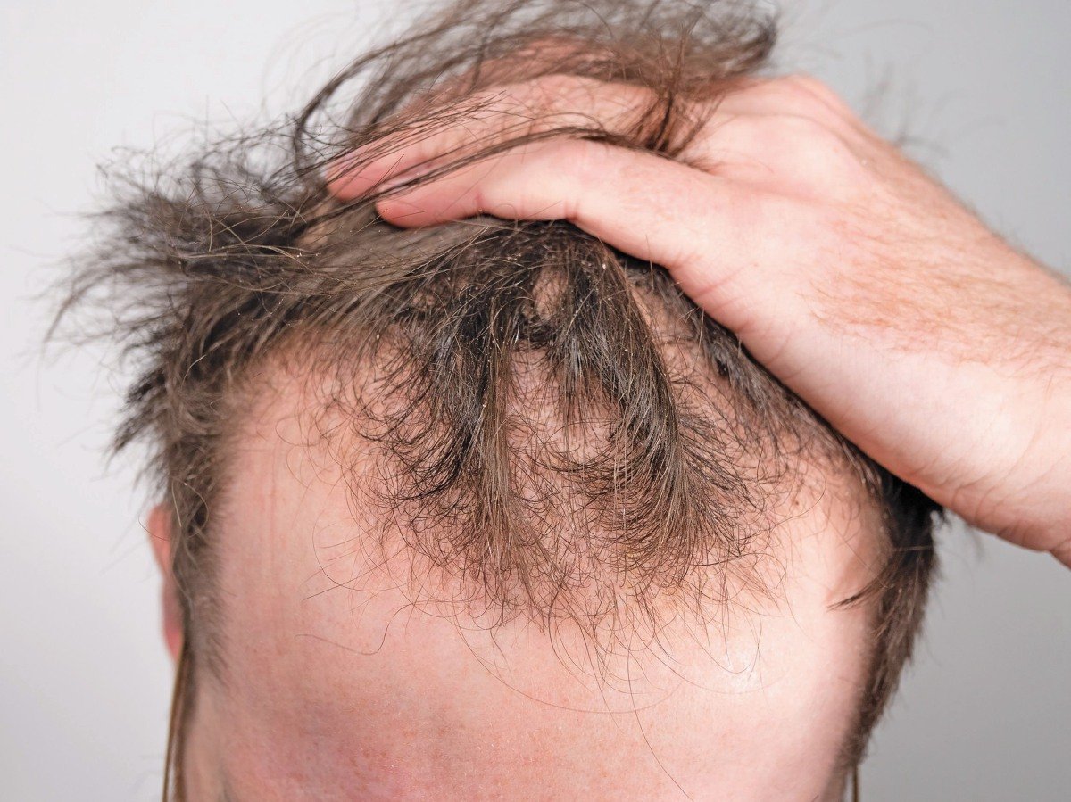 MASALAH botak bahagian depan dan tengah kalangan lelaki mendorong menjalani rawatan tanam rambut 