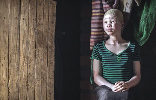 CATHERINE  Amidu, 12, duduk di rumahnya di Malawi, di wilayah tempat  enam albino dibunuh sejak Disember lalu.