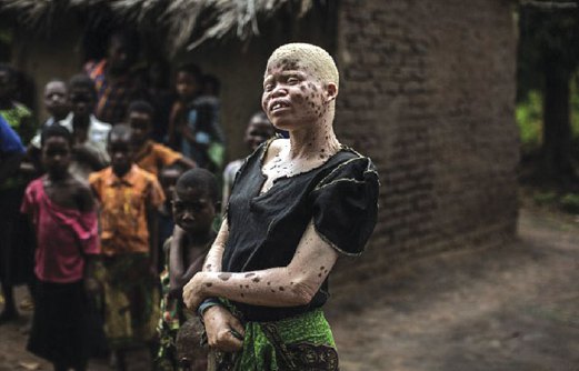 MAINASI Issa, 23, wanita albino Malawi yang berada di bawah perlindungan polis.