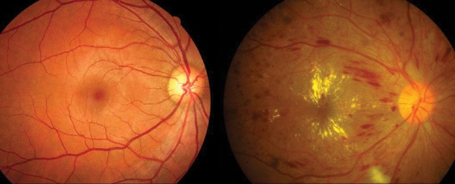 MATA normal dan mata pesakit diabetes yang sudah terjejas menjadi retinopati diabetes.