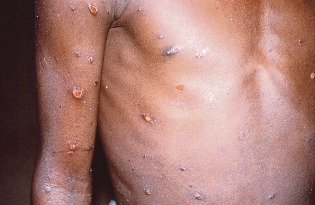 FOTO menunjukkan keadaan kulit badan pesakit cacar monyet di Congo. FOTO fail Reuters 