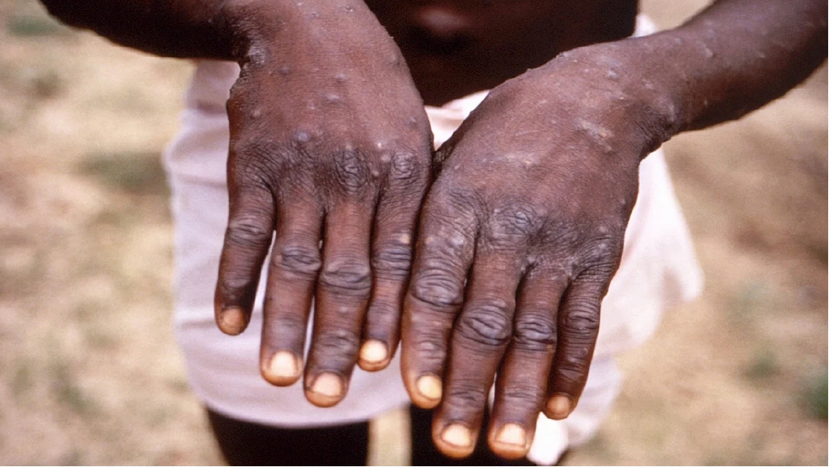 GAMBAR yang dirakam pada 1996 di Congo memaparkan tangan pesakit cacar monyet. FOTO REUTERS