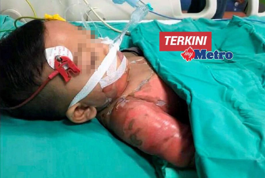 Keadaan Muhammad Aniq yang menerima rawatan akibat melecur terkena air rebusan ketupat di Wad Unit Rawatan Rapi (ICU) Hospital Melaka, Bukit Palah. FOTO Muhammad  Hatim Ab Manan 