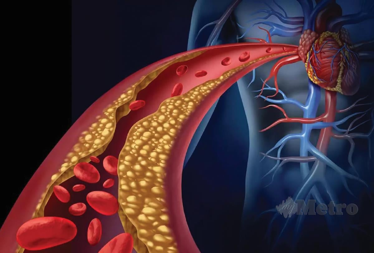 ATEROSKLEROSIS ialah kolesterol plak terkumpul di dalam dinding salur darah arteri manusia. -SUMBER GOOGLE 
