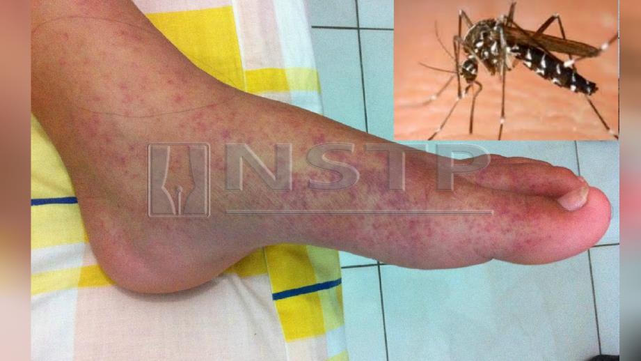 Wabak chikungunya menular di Hatyai, Thailand - Gambar Hiasan 