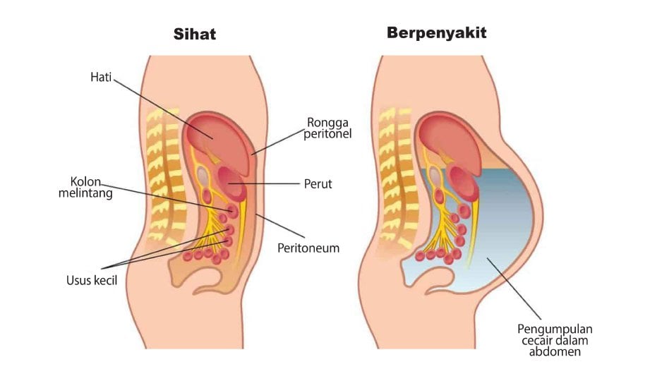 PERUT membusung kerana cecair terkumpul di dalam abdomen akibat komplikasi sirosis.