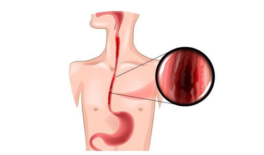 SALURAN darah varices dalam esofagus yang pecah, menyebabkan pesakit muntah darah.