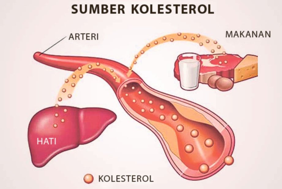 HIPERKOLESTEROLEMIA berlaku apabila terlalu banyak kolesterol di dalam darah.
