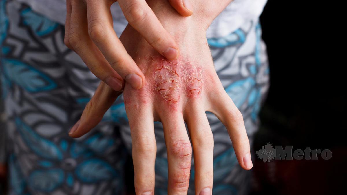 AD adalah masalah kulit yang menyebabkan pesakit menghadapi pelbagai masalah.