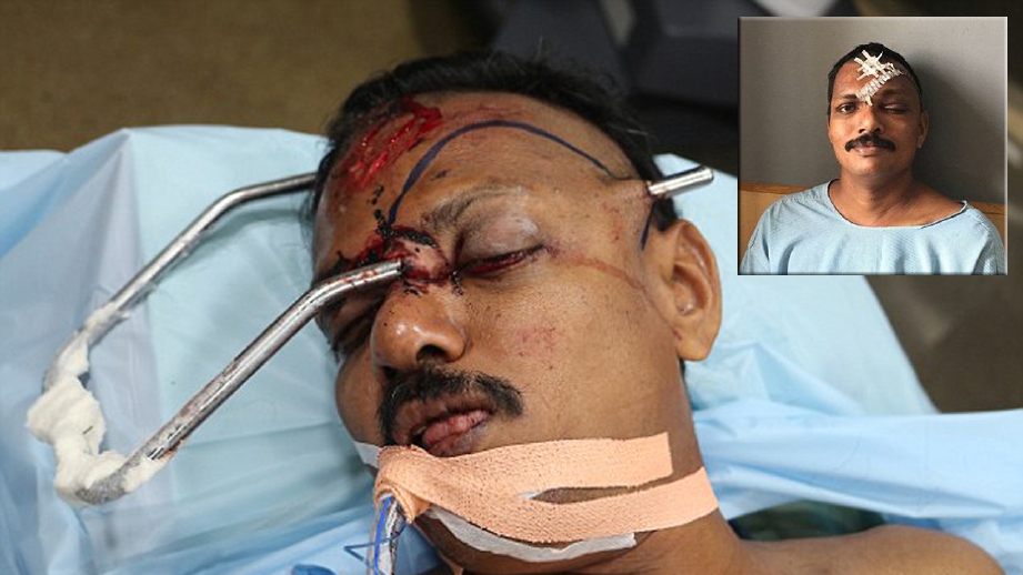 Kumar semakin sembuh selepas doktor melakukan pembedahan mengeluarkan batang besi menembusi kepalanya. FOTO India Photo Agency/SWNS.com