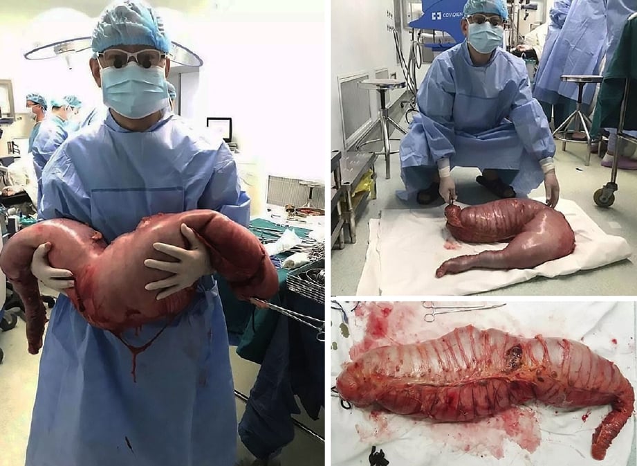 Doktor di China yang membuang 12.7 kilogram najis yang tersumbat dalam usus besar seorang lelaki berusia 22 tahun, terpaksa memotong dan membuang 72 sentimeter usus besarnya (gambar bawah - kiri).  - Foto Daily Mail